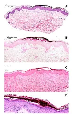 Histopatolog&iacute;a. (a) Se observa condensaci&oacute;n de queratina y dep&oacute;sito de pigmento pardo- negruzco en la capa c&oacute;rnea, que no afecta en mayor medida la epidermis ni la dermis; &uacute;nicamente hay un discreto infiltrado inflamatorio linfocitario perivascular superficial. Hematoxilina y eosina, 4X. (b) Se observa el pigmento en la capa c&oacute;rnea, asociado con una discreta paraqueratosis. Hematoxilina y eosina, 2X. (c) Coloraci&oacute;n negativa para hemosiderina en el pigmento estudiado. Azul de Prusia, 20X. (d) Coloraci&oacute;n positiva para melanina en forma de gr&aacute;nulos negruzcos en el pigmento estudiado. Tinci&oacute;n de Fontana-Masson, 20X.