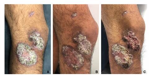 A. Placas verrugosas en la consulta inicial. B. Al terminar el tratamiento con Glucantime®, se observó una discreta disminución de la superficie verrugosa de la placa de la pierna. C. Un mes después, las lesiones eran semejantes a las iniciales.