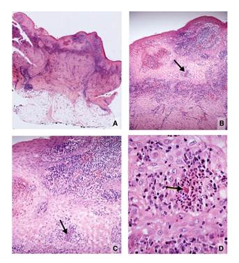 A. Imagen panorámica. Hiperplasia epidérmica e inflamación dérmica difusa con cicatriz profunda. Hipodermis normal. B. Hiperplasia epidérmica, abscesos intraepidérmicos, inflamación dérmica difusa y cicatriz. El absceso intraepidérmico (flecha), se amplía en C y D. C. Hiperplasia epidérmica y el mismo absceso diminuto intraepidérmico (flecha), con estructura eosinofílica central. D. Esta corresponde a una levadura central rodeada por espículas eosinófilas. Es un típico cuerpo asteroide esporotricósico. Hematoxilina y eosina, A: 2,5X; B: 10X; C: 20X; D: 80X.