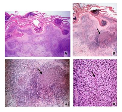 A. Imagen panorámica de la segunda biopsia. Hiperplasia epidérmica, abscesos córneos, senos de drenaje e inflamación dérmica difusa con granulomas centrados por abscesos, uno de ellos voluminoso (derecha). En el centro de la dermis hay cicatriz y un conglomerado de células gigantes. B. Área derecha de la figura anterior. Abscesos córneos y granulomas dérmicos abscedados. La flecha indica un punto eosinófilo en el absceso. C. Mayor aumento de B. Se ven granulomas abscedados y un cuerpo asteroide en el absceso de la derecha correspondiente al punto señalado en la figura anterior. Hay cicatriz dérmica profunda. D. Mayor aumento de C. Cuerpo asteroide esporotricósico dentro del absceso. Hay abundantes plasmocitos periféricos y cuerpos de Russell. Hematoxilina y eosina, A: 4X; B: 4X; C: 10X; D: 40X
