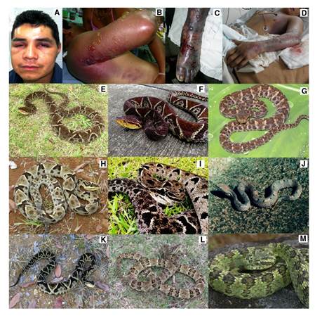 Manifestaciones cl&iacute;nicas y especies asociadas con ofidismo botr&oacute;pico. A. Ofidismo grave por Bothriechis schlegelii. Mordedura en la cara. B. Ofidismo grave por Bothrops rhombeatus.C. Ofidismo grave por Bothropsasper. D. Gangrena por Bothrops asper (Cortes&iacute;a del Hospital Universitario San Jos&eacute;, Popay&aacute;n). E.Bothrops asper. Terciopelo, equis negra. Localidad: corregimiento Huisit&oacute;, municipio El Tambo (cuenca del Pac&iacute;fico), Cauca (Colombia). F.Bothrops asper. Localidad: municipio El Tambo (cuenca del Pac&iacute;fico), Cauca (Colombia), G.Bothrops atrox. Cuatro narices, equis. Localidad: Piamonte, Cauca (Colombia), H.Bothrops ayerbei. Localidad: vereda Pomorroso, corregimiento San Joaqu&iacute;n, municipio El Tambo (cuenca del r&iacute;o Pat&iacute;a), Cauca (Colombia), I. Bothrops ayerbei. Localidad: municipio El Tambo (cuenca del r&iacute;o Pat&iacute;a), Cauca (Colombia), J.Porthidium nasutum. Hilv&aacute;n o patoquilla. Localidad: quebrada Guang&uuml;&iacute;, Timbiqu&iacute;, Cauca (Colombia), K.Bothrops rhombeatus. Equis gata. Localidad: Cajib&iacute;o, Cauca (Colombia), L.Bothrops punctatus. Equis rabo de chucha. Localidad: vereda Playa Rica, municipio El Tambo, Cauca (Colombia), M.Bothriechis schlegelii. Cabeza de candado, yaruma. Localidad: Cajib&iacute;o, Cauca (Colombia).