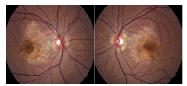 Foto del fondo de ojo de la paciente IV:2. En la angiograf&iacute;a con fluoresce&iacute;na se aprecia el patr&oacute;n de las drusas.