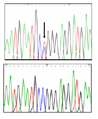 Electroferograma de la variante patog&eacute;nica p.Arg345Trp en el gen EFEMP1. Arriba: secuencia con variante patog&eacute;nica. Abajo: secuencia normal