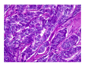 En la microfotograf&iacute;a se aprecia una neoplasia constituida por cordones estrechos de c&eacute;lulas epiteliales displ&aacute;sicas con citoplasma anf&oacute;filo que adoptan un patr&oacute;n expansivo invadiendo el estroma. N&oacute;tese la leve atipia nuclear. Hematoxilina y eosina, 40X.
