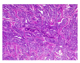 Se observa la distribuci&oacute;n irregular de los nidos entre el estroma colagenizado, esbozando &aacute;reas s&oacute;lidas y cribiformes sin necrosis. En el centro se visualiza un ovillo de gl&aacute;ndulas sudor&iacute;paras que est&aacute;n siendo rodeadas por el tumor. Hematoxilina y eosina, 10X.