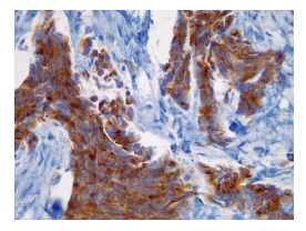 Cromogranina (inmuhistoqu&iacute;mica), 40X.