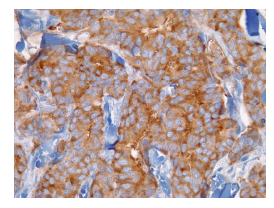 Sinaptofisina (inmunohistoqu&iacute;mica), 40X.