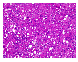 La imagen histol&oacute;gica muestra un tumor formado por c&eacute;lulas grandes, n&uacute;cleos hipercrom&aacute;ticos, nucl&eacute;olos prominentes y m&uacute;ltiples figuras mit&oacute;ticas. El citoplasma es abundante e intensamente eosin&oacute;filo. Hematoxilina y eosina, 40X.