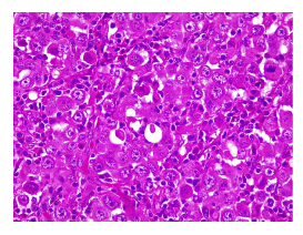 N&oacute;tese la formaci&oacute;n glandular y la presencia de secreci&oacute;n granular eosinof&iacute;lica intraluminal proveniente de la decapitaci&oacute;n de la c&eacute;lula tumoral. Varias c&eacute;lulas presentan gr&aacute;nulos finos citoplasm&aacute;ticos. Los linfocitos maduros que rodean y penetran la neoplasia corresponden a la localizaci&oacute;n ganglionar del tumor. Hematoxilina y eosina, 40X.