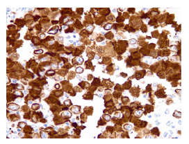 Citoqueratina 7 (inmunohistoqu&iacute;mica), 40X.