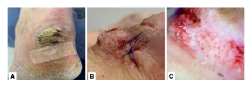 A. Placa de bordes bien definidos, regulares, de color marr&oacute;n claro, hiperquerat&oacute;sica y exof&iacute;tica en el tercio distai de la cara posterior de la pierna izquierda. B. Placa de superficie papilomatosa posterior a la toma de la biopsia. C. En la dermatoscopia, se evidenci&oacute; superficie papilomatosa blanquecina que cubr&iacute;a toda la extensi&oacute;n de la lesi&oacute;n.