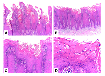 A. Papilomatosis acentuada con hiperqueratosis y acantosis epid&eacute;rmica (Hematoxilina y eosina, 4X). B. Hiperqueratosis, acantosis con elongaci&oacute;n y fusi&oacute;n de la red de crestas epid&eacute;rmicas (Hematoxilina y eosina, 4X). C. Hiperqueratosis, agranulosis, adelgazamiento de los platos suprapapilares y vasos sangu&iacute;neos dilatados en las papilas d&eacute;rmicas (Hematoxilina y eosina, 10X). D. Hiperqueratosis con microabscesos de Munro y agranulosis (Hematoxilina y eosina, 40X).