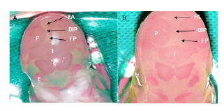 Alteraciones en la osificaci&oacute;n de los huesos del cr&aacute;neo. A: Feto del grupo control. Osificaci&oacute;n completa de los huesos parietales (P), interparietales (I), supraoccipitales (S) y exoccipitales (E). Dimensiones normales de la fontanela anterior (FA), la fontanela posterior (FP) y la distancia interparietal (DIP). B: Feto del grupo diab&eacute;tico. Osificaci&oacute;n parcial de los huesos parietales e interparietales. Fontanelas anterior y posterior anchas, distancia interparietal amplia, cr&aacute;neo en forma de domo