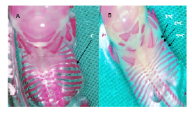 Malformaciones en costillas. A. Feto del grupo control. Osificaci&oacute;n completa de las costillas (C). B. Feto del grupo diab&eacute;tico. Tercera y cuarta costillas fusionadas, quinta costilla bifurcada
