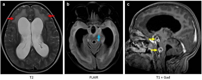 Resonancia magn&eacute;tica cerebral. Im&aacute;genes axiales potenciadas en T2 (a), FLAIR (b) y coronales T1 despu&eacute;s del uso de gadolinio (c). Hidrocefalia no obstructiva supra e infratentorial con hiperintensidades de la sustancia blanca periventricular (flecha roja) correspondiente a edema transependimario por actividad hidrocef&aacute;lica. Aumento de la intensidad de se&ntilde;al en las meninges de la base del cr&aacute;neo (flecha azul) como causa principal de la hidrocefalia por obstrucci&oacute;n del flujo cefalorraqu&iacute;deo y disminuci&oacute;n en su absorci&oacute;n. Se detectaron dos lesiones extraaxiales con realce en anillo, correspondientes a focos de tuberculomas (flechas amarillas).