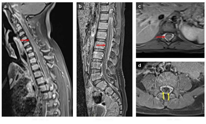 Resonancia magn&eacute;tica de columna. Im&aacute;genes sagitales (a y b) y axiales a nivel tor&aacute;cico (c) y lumbar (d) potenciadas en T1 despu&eacute;s del uso de gadolinio. Realce men&iacute;ngeo en los segmentos cervicales, tor&aacute;cico y lumbar (flecha roja) con realce de las ra&iacute;ces (flecha amarilla)