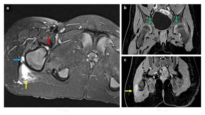 Resonancia magn&eacute;tica de pelvis. Imagen axial potenciada en T2 con saturaci&oacute;n grasa (a) y coronales potenciada en T1 despu&eacute;s del uso de contraste (b y c). Edema del margen lateral del musculo gl&uacute;teo mayor derecho (flecha amarilla) y de vasto lateral del cu&aacute;driceps ipsilateral (flecha azul). N&oacute;tese la presencia de derrame articular coxofemoral (flecha roja) con realce despu&eacute;s del uso de contraste indicativo de sinovitis bilateral (flecha verde).