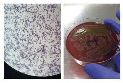 Gram stain, blood culture, and MALDI-TOF results. Left: Blood culture, Gram stain, 100X. Right: Gram-positive rod colonies that grew on blood culture in solid medium, Agar Columbia (BioM&eacute;rieux brand). MALDITOF result: Type of sample: blood culture. Identified microorganism: Bacillus clausii. This is a sensitive and high-precision technique for the identification of microorganisms through mass spectrometry analysis. Methods sequencing the 16s subunit have a 98% concordance for microorganism identification (Score: 2.4, highly reliable identification at genera and species levels)
