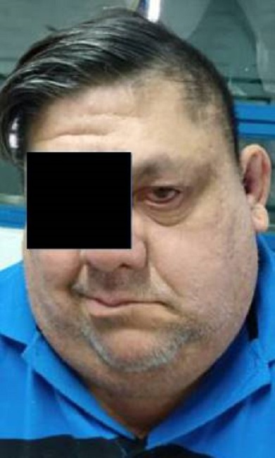 Parálisis facial periférica izquierda con imposibilidad para el cierre palpebral y caída de la comisura labial