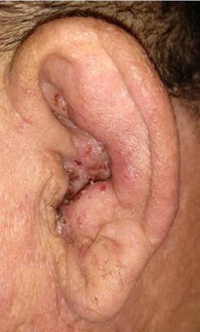 Erupción vesicular costrosa por herpes zóster en el conducto auditivo externo y el pabellón auricular
