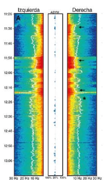 An&aacute;lisis espectral comprimido (CSA) (Philips Intellivue Patient Monitor). Se muestra el an&aacute;lisis de un panel para el hemisferio izquierdo y otro para el derecho; el eje vertical organiza el tiempo, el horizontal, la frecuencia (en Hz) y, en la mitad, aparece el porcentaje de asimetr&iacute;a