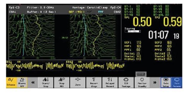 Monitor electroencefalogr&aacute;fico de dos canales de marca Nihon Kohden, modelo BSM- 2354A