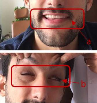 Examen del nervio facial que denota par&aacute;lisis facial izquierda con clasificaci&oacute;n de tipo II en la escala de House-Brackmann: a. Desviaci&oacute;n de la comisura labial izquierda. b. Imposibilidad de cerrar el ojo izquierdo completamente