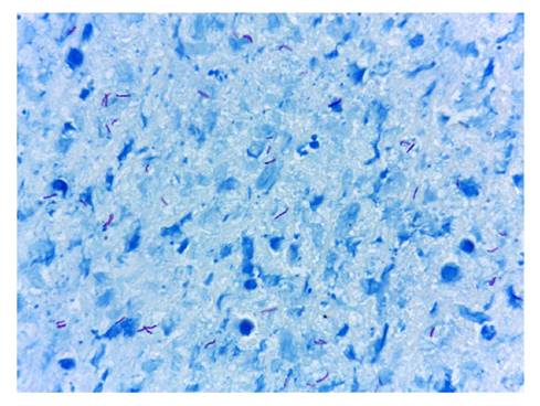 Lavado broncoalveolar, coloraci&oacute;n de Ziehl-Neelsen, 100X