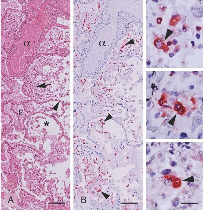 Detection of SARS-CoV-2 antigens in lung tissue of a fatal case with exudative fibrinous pneumonitis and diffuse pulmonary edema. A) Lung tissue in which the alveolus (*), artery (α), and pulmonary edema (£) are observed. The arrow indicates inflammatory cellular infiltrate in the alveolar space. The arrowhead indicates the interalveolar septum where gas exchange takes place, HE stain. B) Arrowheads indicate immunoreaction to SARS-CoV-2 antigens. Images at the right column show viral antigens mainly located in the cytoplasm of inflammatory infiltrate cells, likely macrophages and immune response cells. Immunohistochemistry was performed using the MACH4 Universal AP Polymer Kit™ and visualized with Warp Red. For the detection, a preparation of rabbit anti-SARS nucleocapsid protein antibody (Novus Biologicals-NB100-56576, 1:100 dilution in DaVinci green diluent - Biocare Medical) was used. Scales in A and B = 50 μm; scales in the enlarged right column images = 10 μm