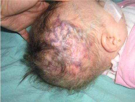 Paciente con síndrome de Adams-Oliver con dilatación y tortuosidad venosa en el cuero cabelludo