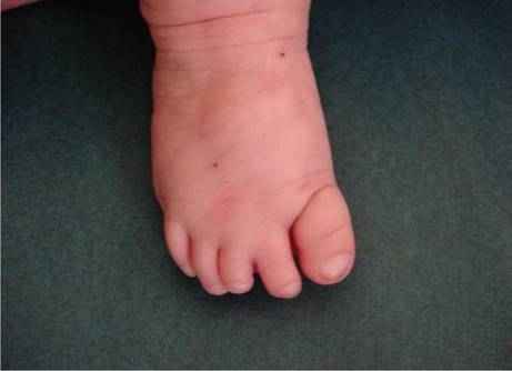 Cutis marmorata telangiectásica y defectos transversales en los dedos de los pies. En el pie derecho se observa sindactilia entre el segundo y el tercer dedo, hipoplasia del tercero y uñas displásicas, con un pliegue cutáneo profundo que rodea el primer dedo o dedo gordo.