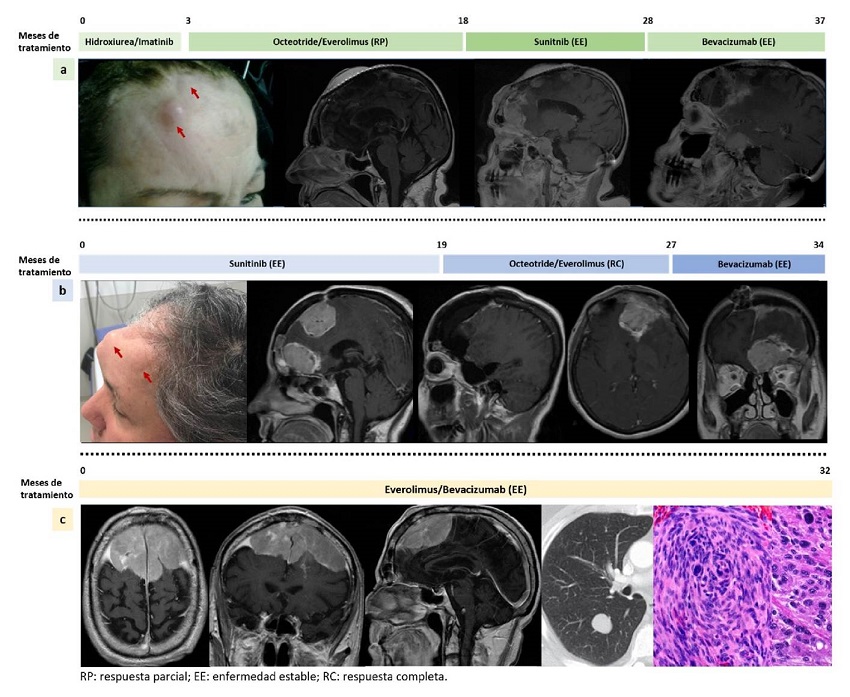 a. Mujer de 54 a&ntilde;os con diagn&oacute;stico de meningioma anapl&aacute;sico recurrente en tres oportunidades y con TERT silvestre, tratada en tres oportunidades con cirug&iacute;a, radioterapia de intensidad modulada, radiocirug&iacute;a, y con la serie de medicamentos everolimus, sunitinib y bevacizumab; con este tratamiento, alcanz&oacute; una supervivencia global de 37 meses. b. Mujer de 59 a&ntilde;os a quien se le diagnostic&oacute; meningioma anapl&aacute;sico con la mutaci&oacute;n TERTC228T . Su evoluci&oacute;n fue r&aacute;pida a pesar de dos intervenciones neuroquir&uacute;rgicas parciales, de radioterapia de intensidad modulada y de la administraci&oacute;n de la serie de medicamentos sunitinib, everolimus y bevacizumab; con este tratamiento se logr&oacute; una supervivencia global de 39,5 meses, 34 de los cuales estuvo en tratamiento m&eacute;dico. c. Hombre de 47 a&ntilde;os con diagn&oacute;stico de meningioma anapl&aacute;sico bifrontal de gran tama&ntilde;o, con extensi&oacute;n &oacute;sea y pulmonar, que present&oacute; la mutaci&oacute;n TERTC228T . Fue tratado con ex&eacute;resis parcial, radioterapia de intensidad modulada y la combinaci&oacute;n de everolimus y bevacizumab; con este tratamiento, ha tenido una supervivencia global de la enfermedad de 32 meses hasta el momento.