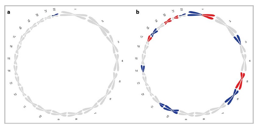 Alteraciones cromos&oacute;micas m&aacute;s frecuentes en los meningiomas de grado I-III. a. La monosom&iacute;a 22 es la alteraci&oacute;n m&aacute;s com&uacute;n en los meningiomas, relacionada con una ganancia en el n&uacute;mero de copias y, con frecuencia, el &uacute;nico evento en los tumores de grado I. b. Las alteraciones recurrentes en el n&uacute;mero de copias de los cromosomas coloreados son una caracter&iacute;stica distintiva de los meningiomas de alto grado. El azul denota la p&eacute;rdida cromos&oacute;mica y, el rojo, la ganancia.