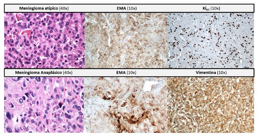 En la franja superior, se muestra la secuencia patol&oacute;gica de un meningioma at&iacute;pico (OMS II) con un alto &iacute;ndice mit&oacute;tico (mayor o igual a 4/10 campos de mayor aumento); arquitectura de laminaci&oacute;n, formaci&oacute;n de c&eacute;lulas peque&ntilde;as, &ldquo;hipercelularidad&rdquo;, macronucl&eacute;olos y necrosis. Las im&aacute;genes ilustran, adem&aacute;s, la proliferaci&oacute;n medida por el Ki67, al igual que la expresi&oacute;n del ant&iacute;geno epitelial de membrana (EMA). En la porci&oacute;n inferior de la imagen, se muestra la histolog&iacute;a de un meningioma anapl&aacute;sico (OMS III) con m&aacute;s de 20 mitosis por 10 campos de mayor aumento, importante pleomorfismo celular y nuclear, y aspecto sarcomatoide.