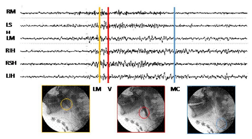 Posicionamiento de los marcadores sobre l&iacute;nea mandibular (LM), vallecula epigl&oacute;tica (V) y m&uacute;sculo cricofar&iacute;ngeo (MC)