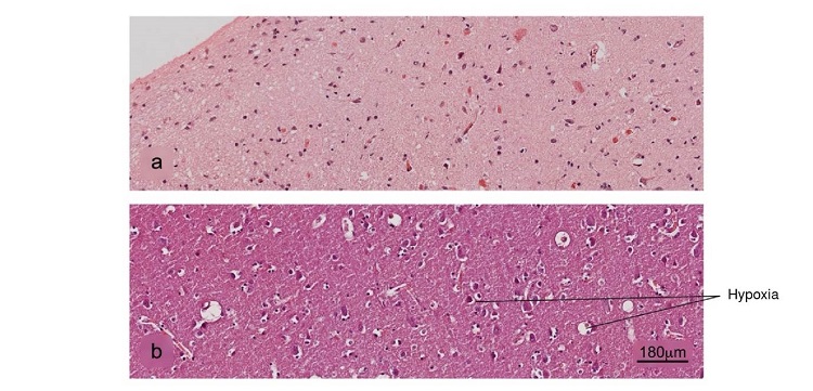 Histopathological alterations in brain tissue associated with COVID-19. a) Normal histology of the cerebral cortex, b) acute hypoxic lesion and c) encephalitis. H&E stain.