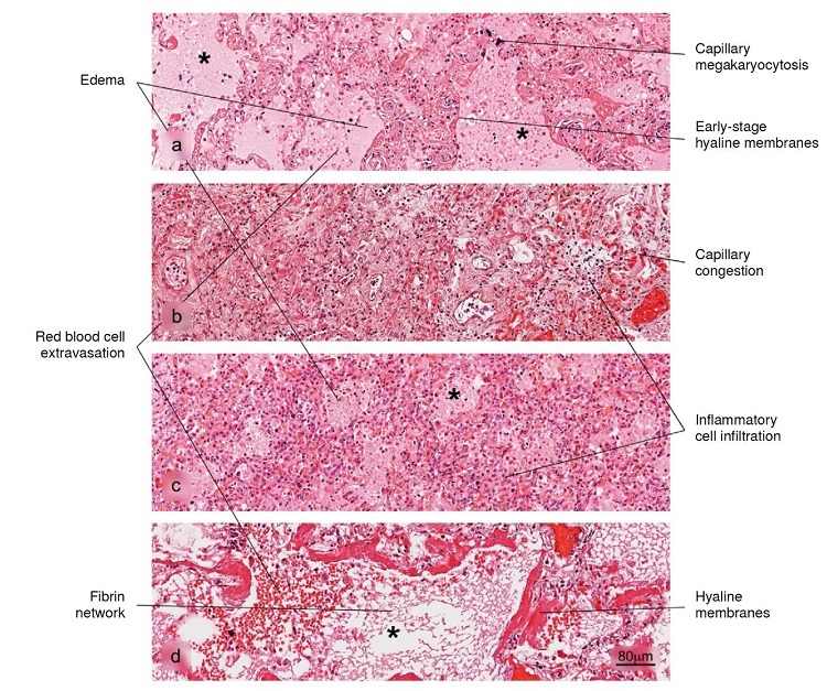 Histopathological alterations in lung tissue associated with COVID-19. The different phases of diffuse alveolar damage (DAD) observed in fatal cases are illustrated: a) acute, b) acute proliferative, c) proliferative and d) fibrotic. Pulmonary alveolus (*). H&E stain.