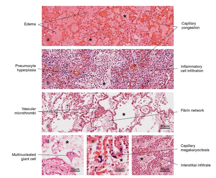 Histopathological alterations in lung tissue associated with COVID-19. a) edema, characterized by the presence of protein content in the alveolar regions, b) reactive pneumocyte hyperplasia, c) vascular microthrombi, d) presence of multinucleated giant cells, e) capillary megakaryocytosis and f) lymphocytic interstitial infiltrate. Pulmonary alveolus (*). H&E stain.