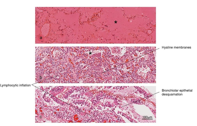 Histopathological alterations in lung tissue associated with COVID-19. a) pulmonary infarction, b) acute pneumonitis with fibrinoid exudate, c) bronchiolar inflammation. Pulmonary alveolus (*). H&E stain. 