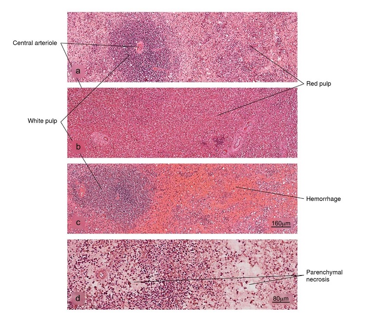 Histopathological alterations in splenic tissue associated with COVID-19. a) Normal histology of the spleen in which a lymphatic node - white pulp - and an extensive area of red pulp is observed, b) reduction in the white pulp, c) hemorrhage in the red pulp, d) parenchymal necrosis. H&E stain.