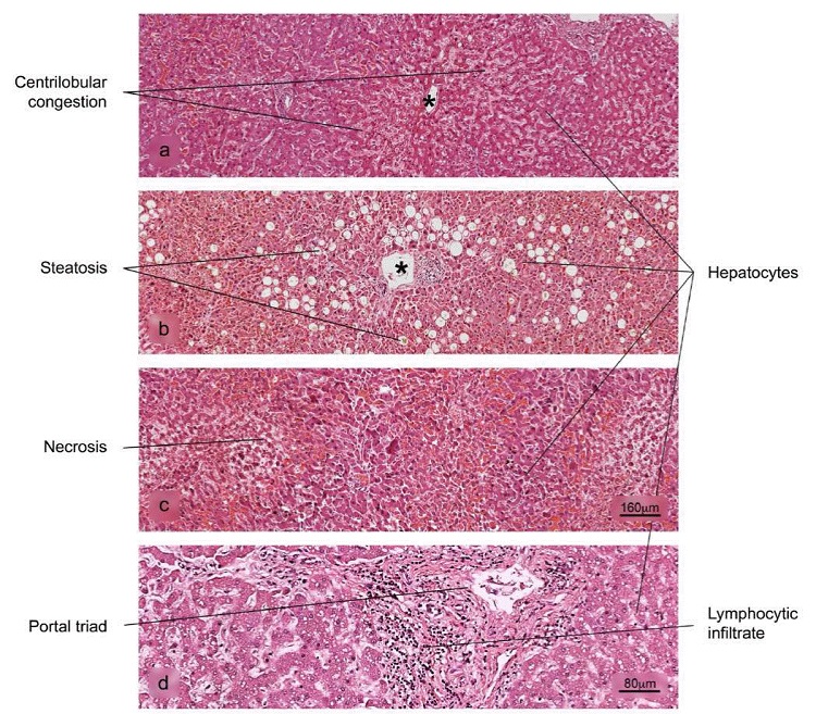 Histopathological alterations in liver tissue associated with COVID-19. a) sinusoidal congestion, b) fatty liver degeneration - macro- and microvesicular steatosis, c) necrosis, d) lymphocytic infiltrate of the portal triad. H&E stain.