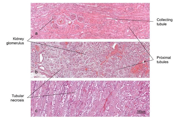 Histopathological alterations in kidney tissue associated with COVID-19. a) Normal histology of the kidney. Renal corpuscles are observed in the cortex. b) and c) Acute duct necrosis. H&E stain. 