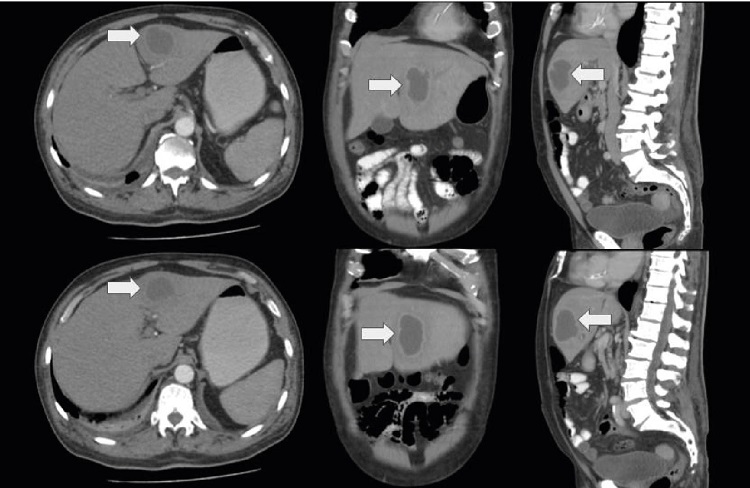 Computed tomography of abdomen and pelvis with intravenous contrast. The arrow shows a variable density internal pattern of a hypodense lesion in relation to the liver parenchyma, compatible with an abscess in the left hepatic lobe. 