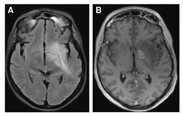 Focos de cerebritis en el ganglio basal en secuencia FLAIR (A) y T1 despu&eacute;s del contraste (B)