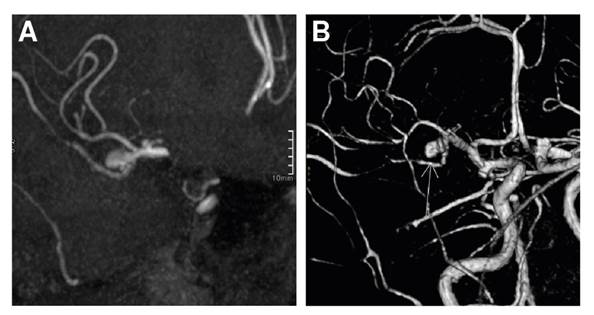 Aneurisma sacular en secuencias en tiempo de vuelo MIP (A) y 3D (B)