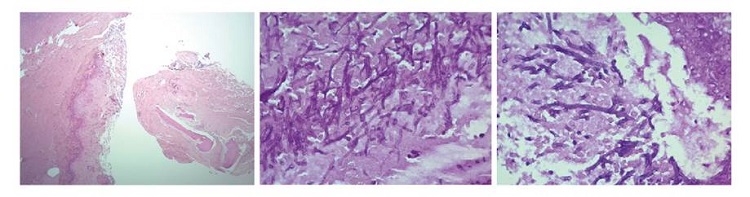 (A) Tejido conectivo denso y &oacute;seo desvitalizado con dos formas de hongos filamentosos (H&E, 4X) , uno con hifas delgadas septadas ramificadas (B) y otro con hifas hialinas anchas sin septos con objetivo de 40X (C)