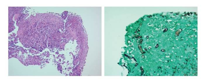(A) Mucosa g&aacute;strica ulcerada con una inflamaci&oacute;n cr&oacute;nica granulomatosa (H&E, 10X), asociada a un hongo filamentoso con hifas hialinas anchas no septadas (coloraci&oacute;n de Gomory 40X) (B).