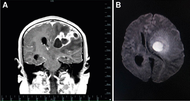 Resonancia magn&eacute;tica cerebral con equipo de 1.5 Tesla con protocolo rutinario para cerebro, sin administraci&oacute;n endovenosa de contraste paramagn&eacute;tico y con contraste, con secuencia de difusi&oacute;n y mapa param&eacute;trico (mapa del coeficiente de difusi&oacute;n aparente). A. Secuencia potenciada en T1 con contraste paramagn&eacute;tico: se observa una lesi&oacute;n cortico- subcortical que ocupa espacio, en la regi&oacute;n fronto-t&eacute;mporo-parietal izquierda, que compromete la sustancia blanca profunda y el ganglio basal superior; existe un componente s&oacute;lido que se realza intensamente y &aacute;reas de caracterizaci&oacute;n qu&iacute;stica con realce perif&eacute;rico en patr&oacute;n anular. B. En la secuencia potenciada en difusi&oacute;n (Diffusion-weighted imaging), tiene comportamiento de patr&oacute;n restrictivo, efecto compresivo y desplazamiento de las cavidades del sistema ventricular con herniaci&oacute;n del c&iacute;ngulo por debajo de la hoz del cerebro.