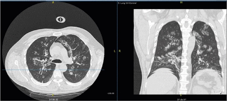 Cortes axial y coronal que evidencian m&uacute;ltiples opacidades con &aacute;reas de atenuaci&oacute;n en vidrio esmerilado de predominio central, con compromiso de ambos campos pulmonares, que sugiere ser el foco primario de la diseminaci&oacute;n de la infecci&oacute;n por Nocardia spp.