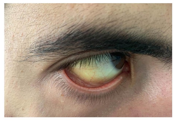 Escleróticas ictéricas